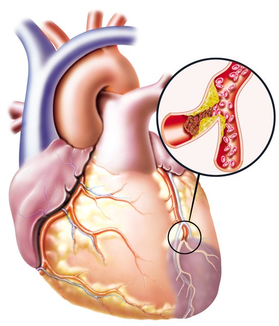 Imagen de un corazón con alteración del flujo sanguíneo y obstrucción de un vaso sanguíneo.